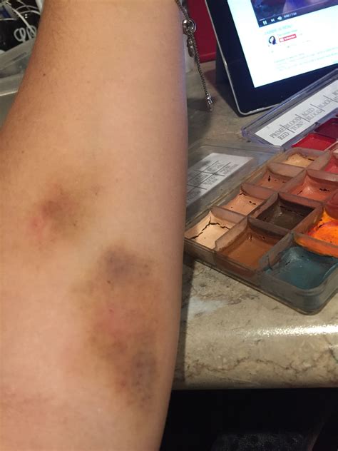 fake bruise|aesthetic bruises makeup.